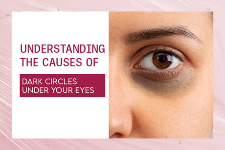 Understanding the causes of Dark Circles Under your eyes